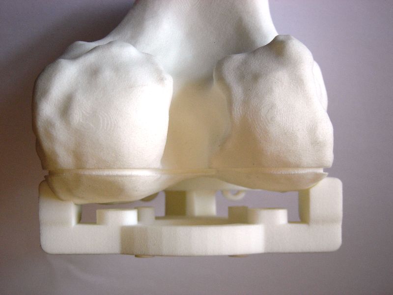 Posterior view of femoral block mounted on femoral model showing contact between block and distal femur
